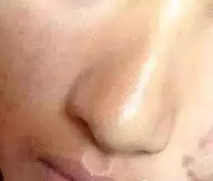 背后长很多小米粒该怎么办,背后长了很多的小米粒用什么药