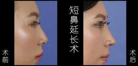 鼻子整形的方法有几种,鼻子整形方法都有哪些图片