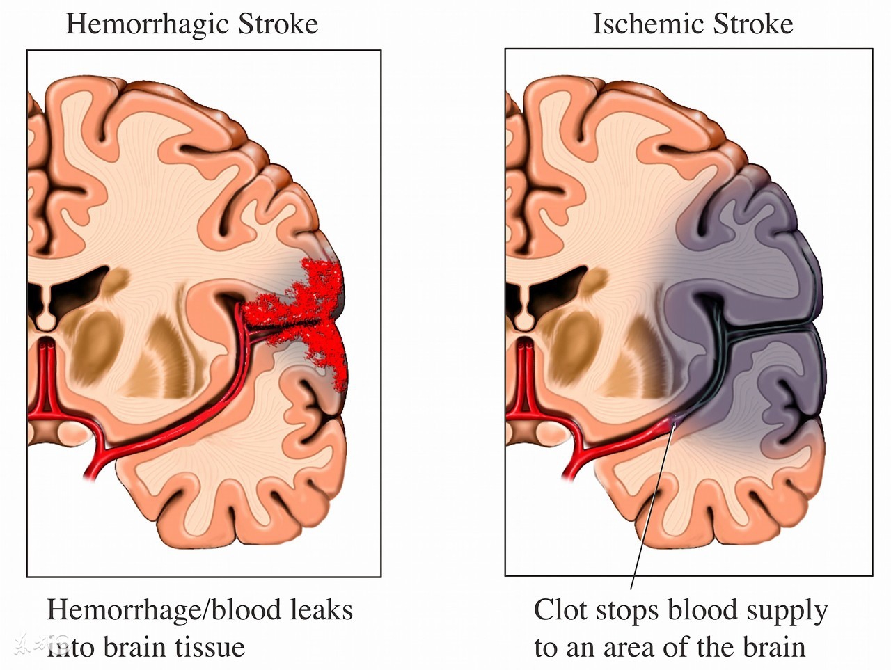 家里老人忽然中风如何缓解,家里老人中风怎么照顾最好