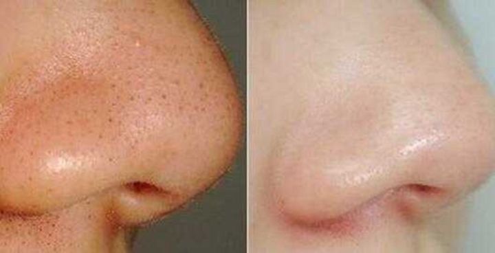 厨房里有非常微小的虫是什么,黑头克星食物