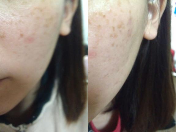 果酸换肤科普视频,果酸营养焕肤