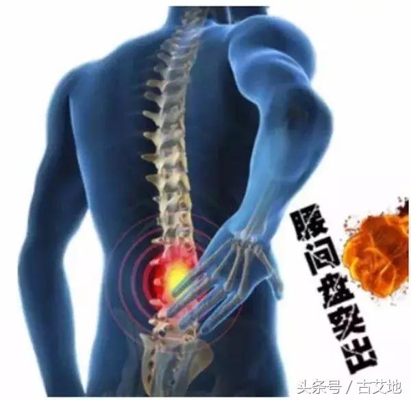 腰椎间盘突出到底应该怎么治,腰椎间盘突出到底应该怎么治疗