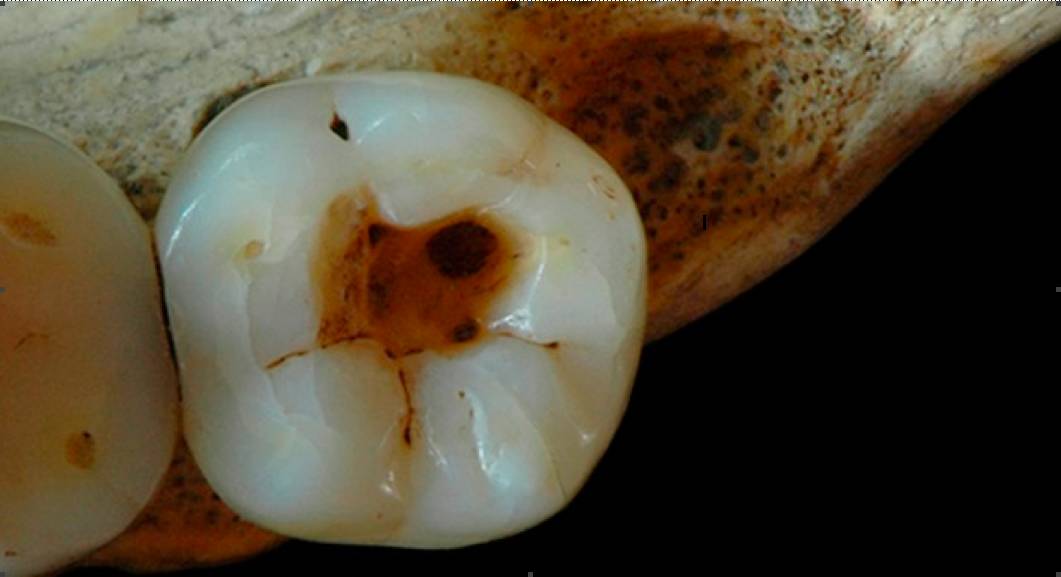 牙齿痛的小知识,牙很疼又不能拔牙怎么缓解疼痛