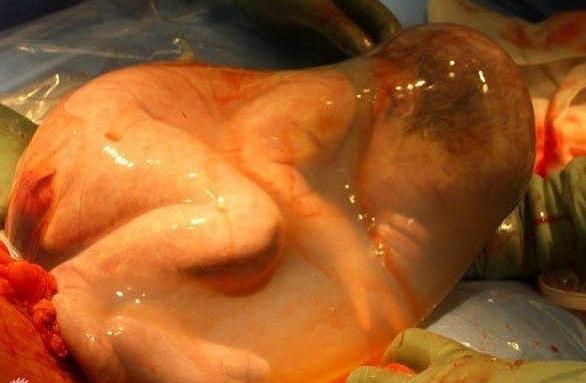 实拍胎儿剖腹产过程，“捧在手里怕摔了，含在嘴里怕化了”！