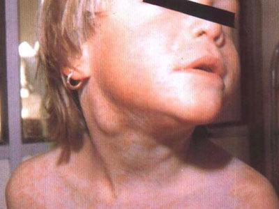 颈部肿了一块是怎么回事,颈部突然肿了一个大包