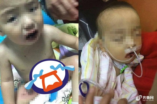 家长长点心吧,一岁宝宝误食烧碱口腔溃烂