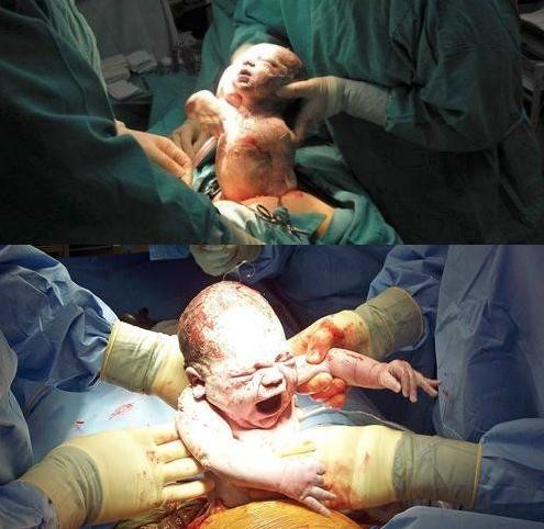 实拍胎儿剖腹产过程，“捧在手里怕摔了，含在嘴里怕化了”！