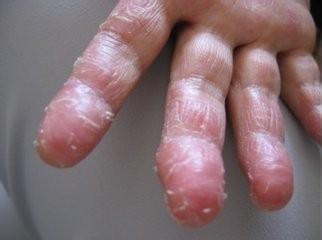 手掌癣脱皮干裂,双手对称蜕皮裂口是不是手癣