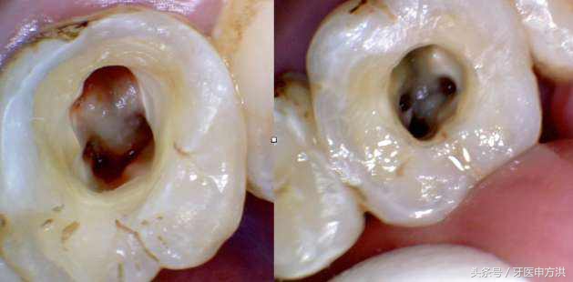 做根管治疗牙齿是不是就废了？