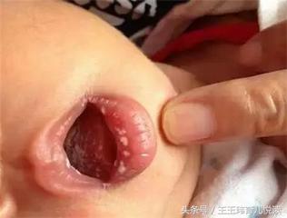 2岁前小宝宝口腔最爱得这病，妈妈做好这些预防工作，宝宝更健康