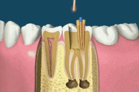 做根管治疗牙齿是不是就废了？