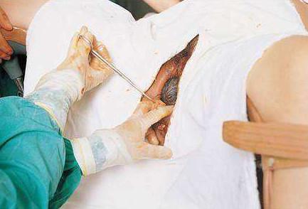 孕妇为啥侧切左边,缝合侧切伤口打麻药会疼吗