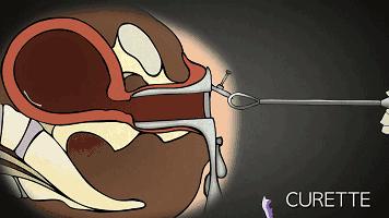 人流对生娃有什么影响,人流跟生孩子哪个危害更大