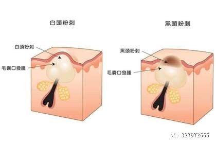 朵嘉浓祛痘凝胶好不好,朵嘉浓闭口粉刺