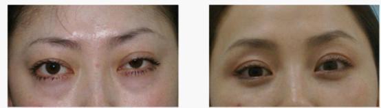 甲减患者会出现精神抑郁是真的吗,甲减为什么容易抑郁