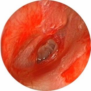 鼓膜挫伤听力下降,鼓膜外伤怎么处理