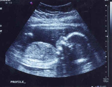 b超查卵泡用憋尿吗?卵泡检查需要憋尿吗?监测卵泡需要空腹吗?