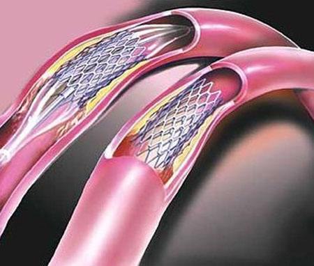 心脏支架可以做头部磁共振吗,心脏装支架可否做头颅磁共振