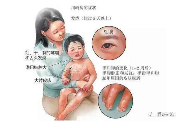 小朋友高烧反复后出现疹子,儿童高烧不退起红疹