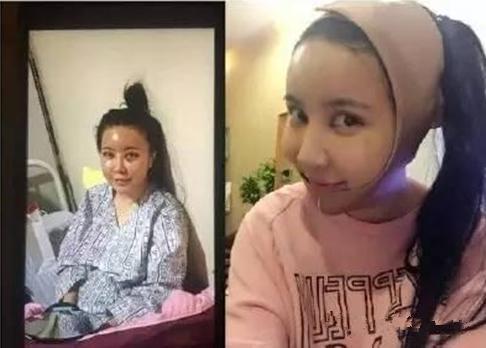 隆鼻后很疼,隆鼻后单纯的肿胀没有疼痛的感觉