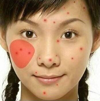 「看图识别长痘原因」还在苦恼长痘，如何祛痘，点开此文绝不后悔