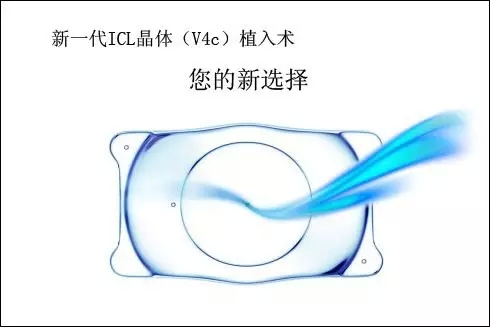 兰州普瑞眼科近视手术费用,兰州近视眼植入晶体