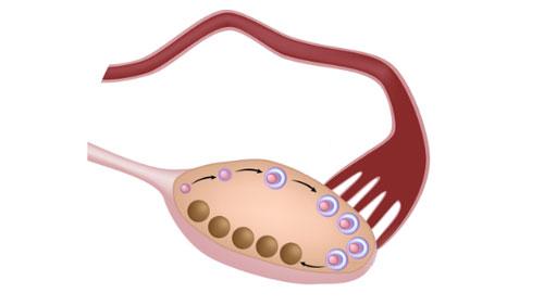 多囊卵巢综合症有什么症状表现,多囊卵巢综合症的症状和危害