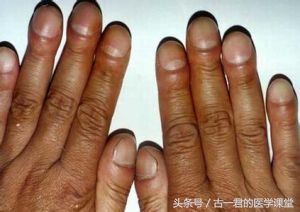 支气管扩张是大病吗,支气管扩张