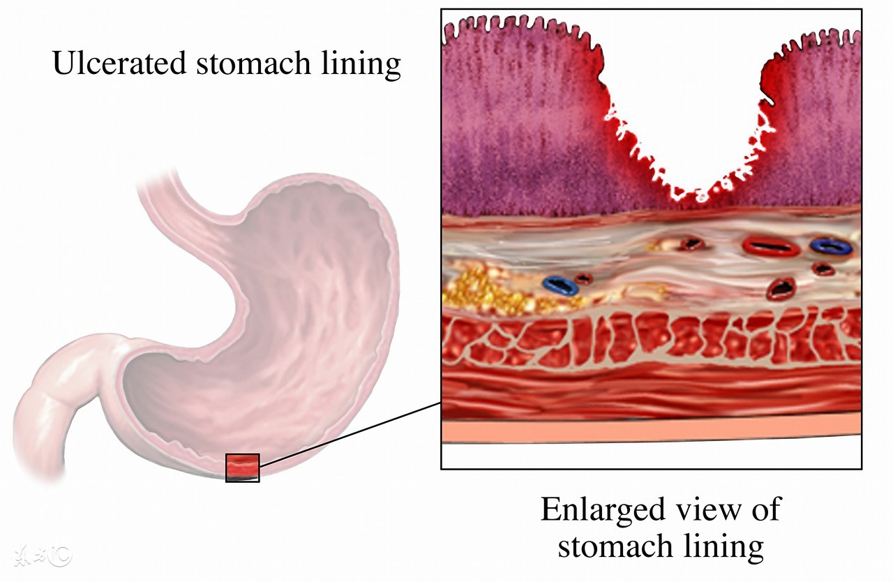 迷走神经电刺激疗法的作用是,迷走神经刺激术治疗副作用