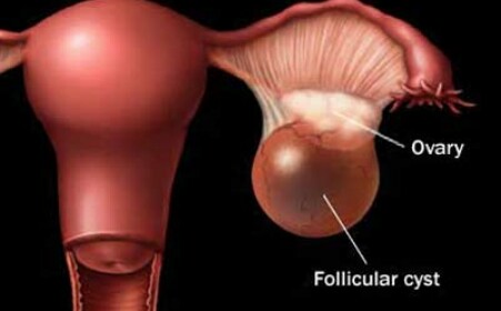 卵巢囊肿影响怀孕吗,右侧卵巢囊肿怎么办