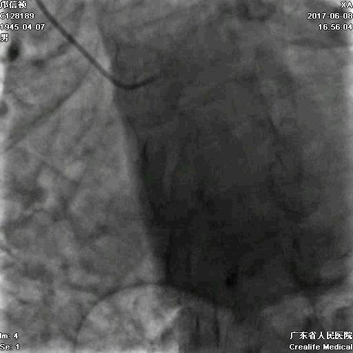 冠脉介入术的介绍,复杂冠脉介入病例