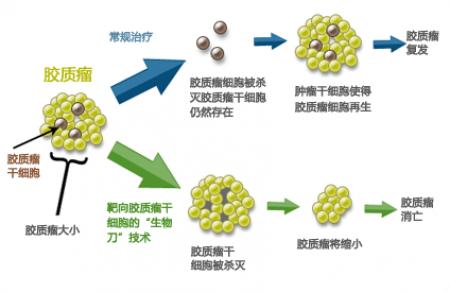 脑胶质瘤引起癫痫的原因,恶性脑胶质瘤癫痫后能活多久