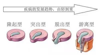 颈椎间盘突出症病例,颈椎间盘突出症状及治疗方法