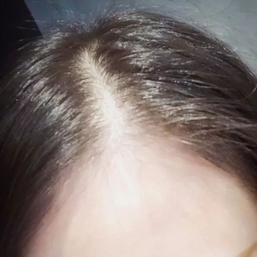 90后的叔叔阿姨，你的头发掉了