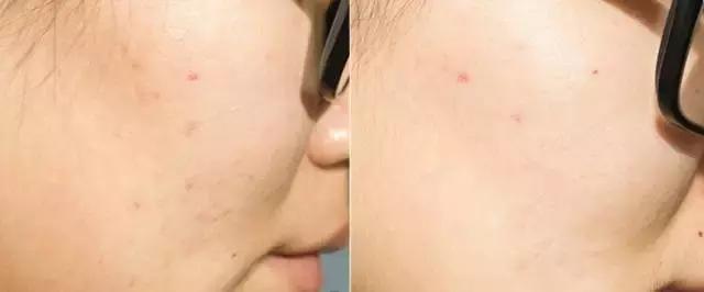 痘痘不长出来也不消怎么办,脸上的痘印持久不消