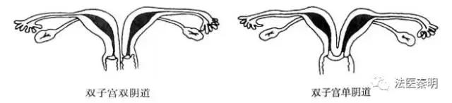 三胞胎在一个子宫吗,三胎双胞胎单角子宫