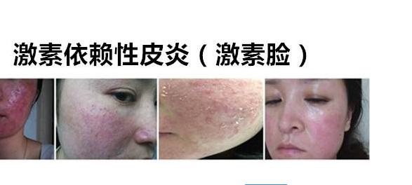 脸上皮肤发红发痒还有皮屑,脸上发红发烫是激素脸吗