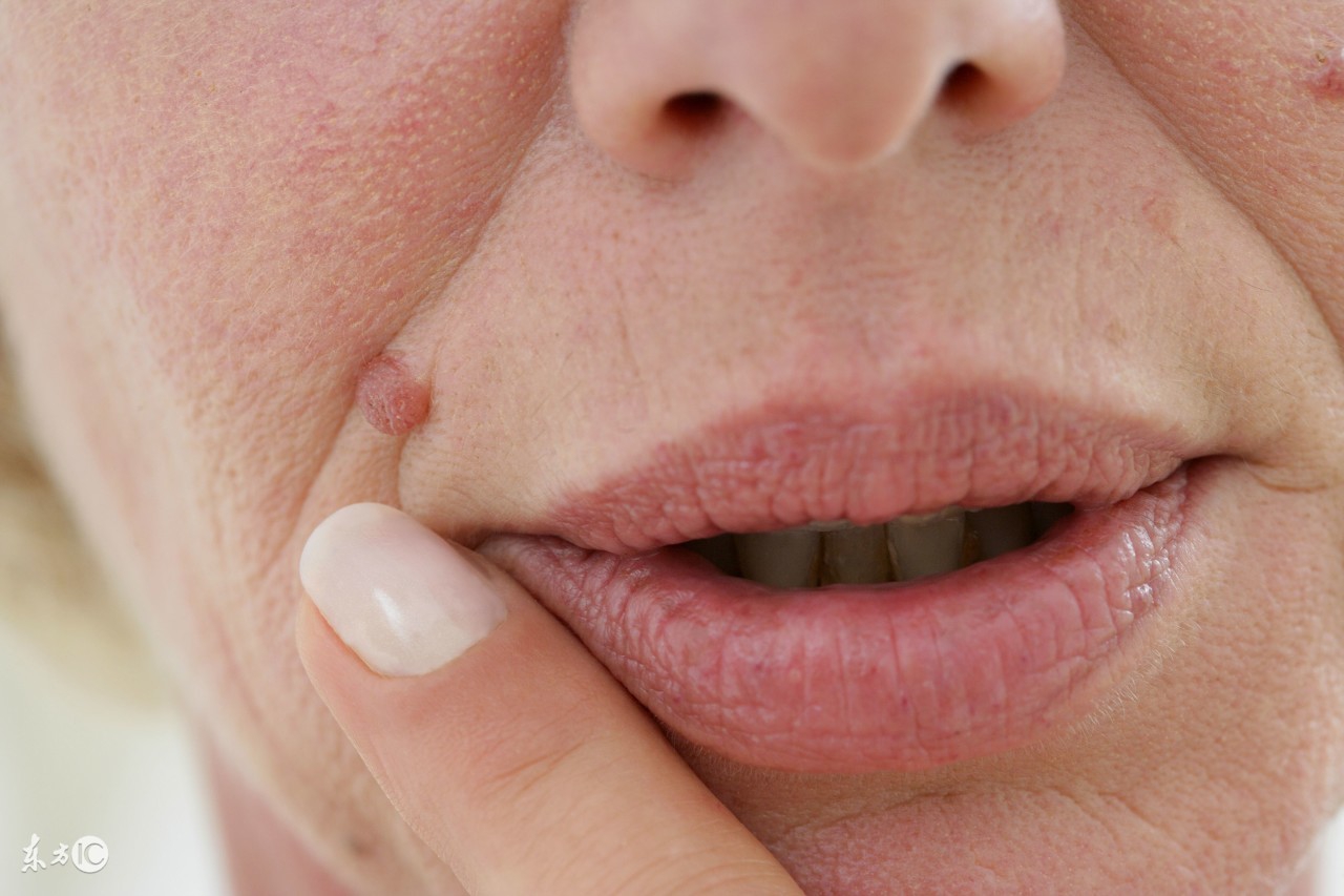 蜘蛛痣会突出表面么,出血类疾病会导致蜘蛛痣吗