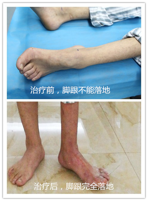 脑瘫病人康复费用,脑瘫8年康复大概需要多少钱