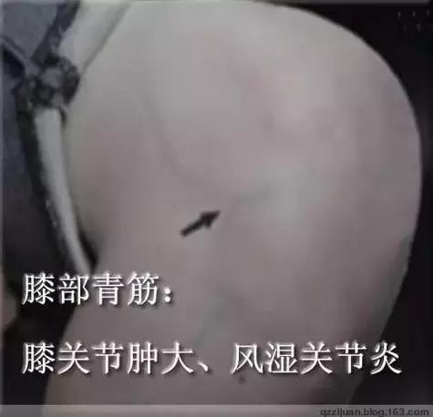 青筋的手诊方法,全身青筋诊病全集
