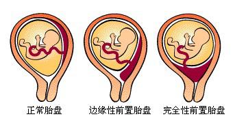 12周胎盘低置状态,低置胎盘1-2度