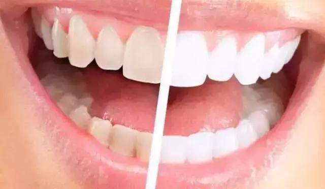 做烤瓷牙后悔的人,做烤瓷牙的人都后悔吗