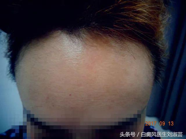 白斑患者的真实生活,白斑患者自述