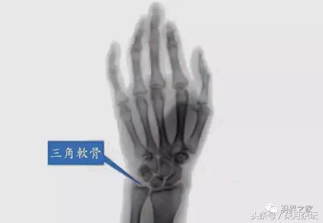 打羽毛球手腕疼的康复,打羽毛球手腕内侧疼怎么恢复