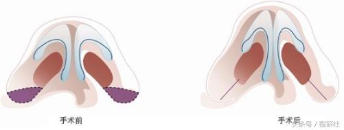 甜美少女养成计——俊翘美鼻