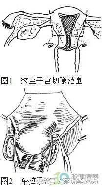 子宫次全切术后会出血吗,子宫次全切手术还会怀孕吗