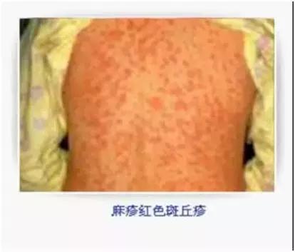 麻疹的预防和护理措施,麻疹最佳防治方法