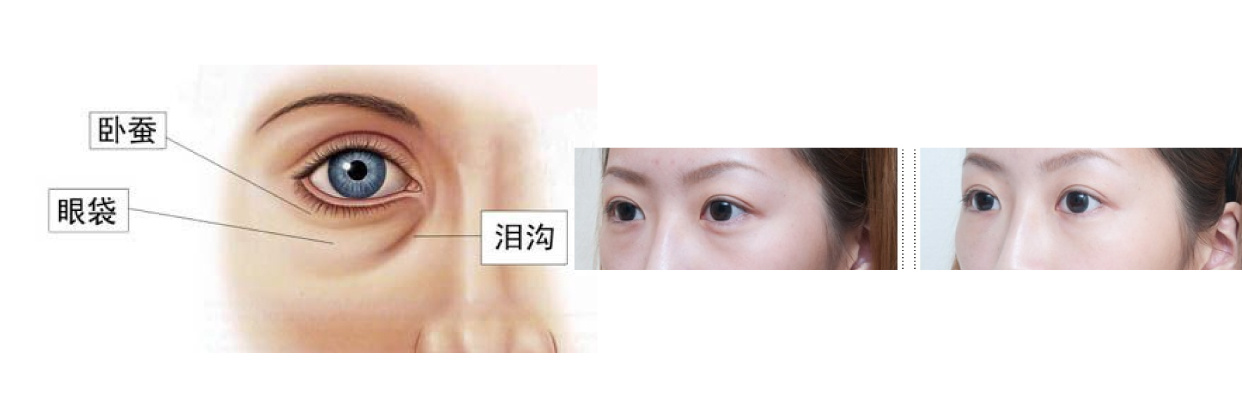 鱼子酱淡化泪沟眼袋黑眼圈眼霜,淡化黑眼圈眼袋泪沟哪个眼霜好