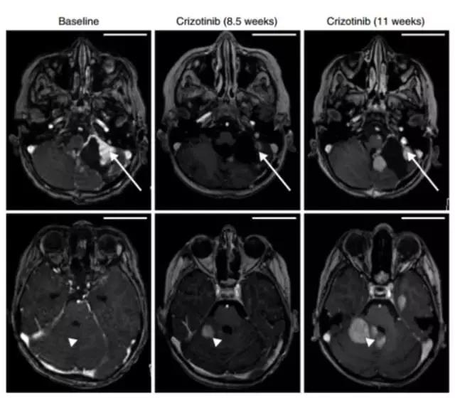 脑胶质瘤靶向药有哪些,脑干弥漫中线胶质瘤靶向药物