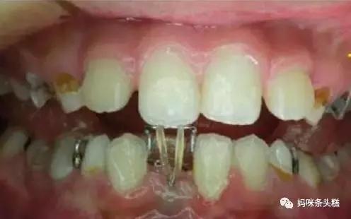 恒牙过大萌出时过早顶掉乳牙,乳牙已掉三个月怎么不长新牙